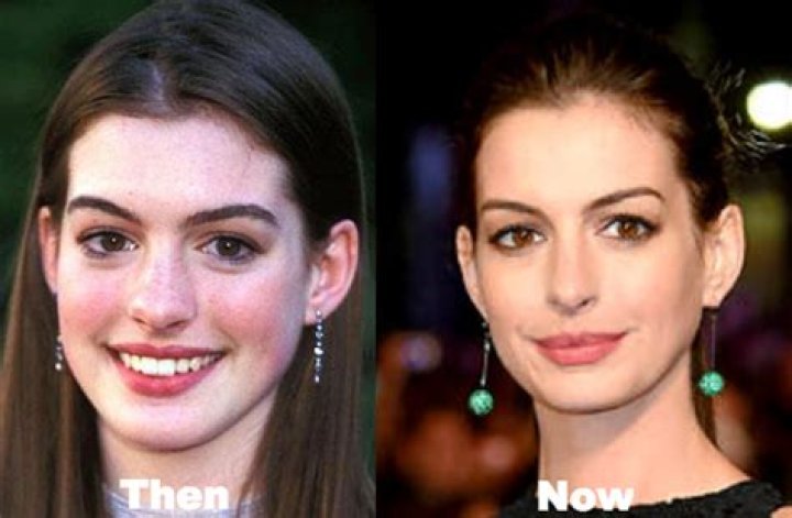 Did Anne Hathaway Undergo Plastic Surgery Or Not? Did Anne Hathaway Undergo Plastic Surgery Or Not?