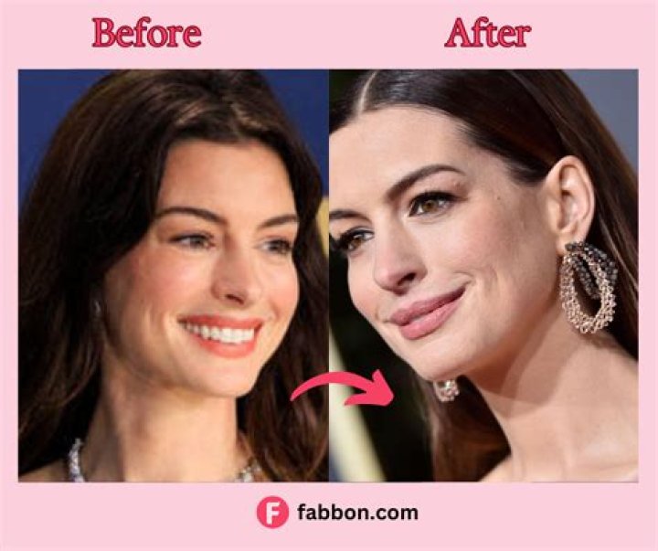 Has Anne Hathaway Done Botox Surgery And Lip Filler?