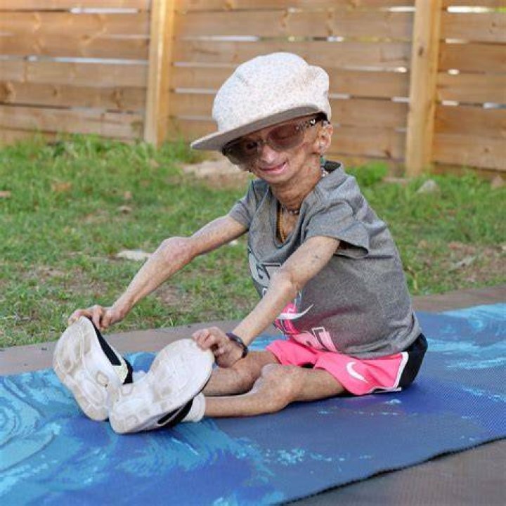 Is Adalia Rose Still Alive Or Dead? What Happened To Her And Eyes? Her Disease & Condition Progeria Syndrome Update