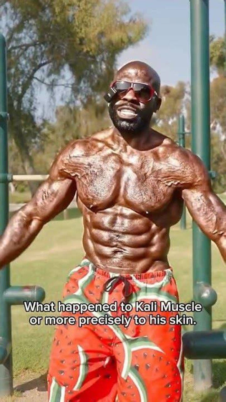 Unraveling The Mystery: What Happened To Kali Muscle Skin?