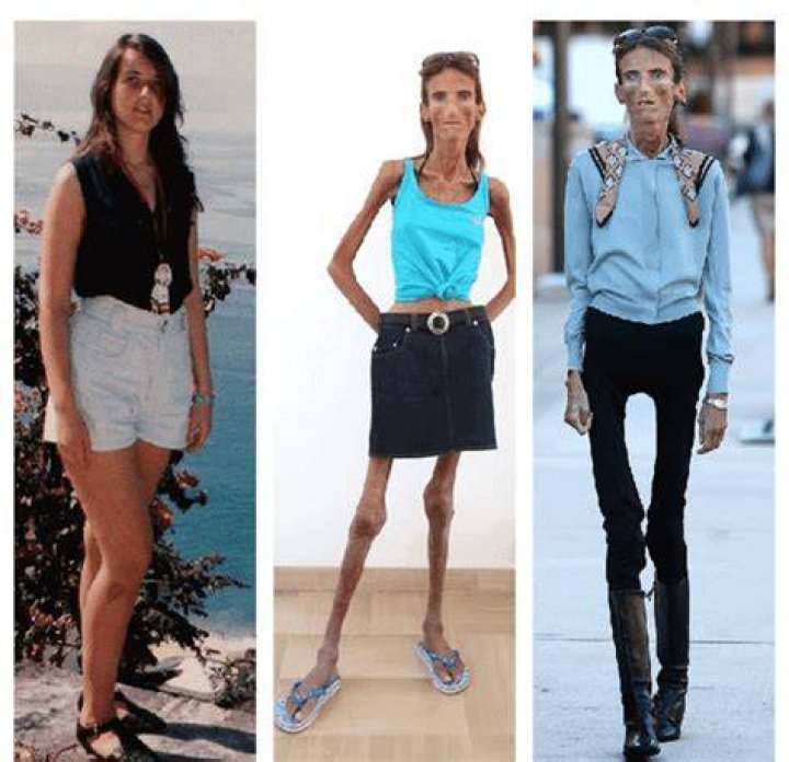 Unveiling The Mystery Of The Skinniest Person In The World