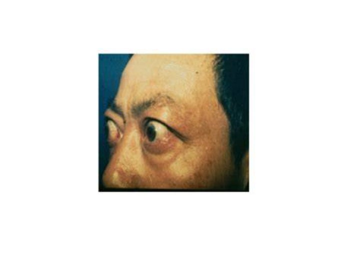 非浸潤性突眼_百度百科